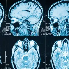 Przekroje mózgu na rezonansie magnetycznym. Widoczne są różne płaszczyzny badania, które mogą pomóc w diagnostyce takich schorzeń jak guz mózgu objawy.
