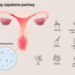 Ilustracja przedstawia przyczyny zapalenia pochwy, w tym infekcje intymne, cukrzycę i zaburzenia hormonalne.