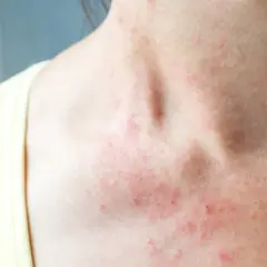 Skóra na szyi i dekolcie jest zaczerwieniona i podrażniona. Może to być objaw alergii lub innej choroby skóry, którą leczy się np. **locoid lipocream**.