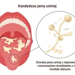 Obraz przedstawia jamę ustną z białymi nalotami na języku i podniebieniu, co jest objawem kandydozy. Powiększony fragment pokazuje drożdżaki Candida albicans.