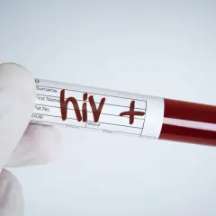 Rękawiczka medyczna trzyma probówkę z krwią oznaczoną "hiv +". Wynik testu na aids jest pozytywny.