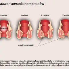 Ilustracja pokazuje cztery stopnie zaawansowania hemoroidów, od I do IV, z widocznymi zmianami w okolicy odbytu. W zaawansowanych stadiach może wystąpić krwawienie z odbytu.