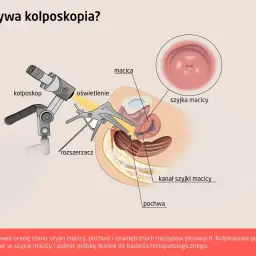 Ilustracja przedstawia kolposkopię: kolposkop, rozszerzacz i szyjkę macicy. Badanie to wykrywa zmiany przedrakowe.