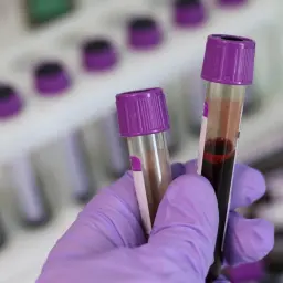 Ręka w fioletowej rękawiczce trzyma probówki z krwią. To próbki do badań, np. PDW co to jest, analizowane w laboratorium.