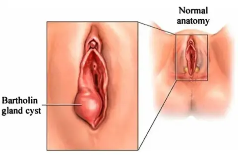 Ilustracja pokazuje powiększony gruczoł Bartholina, który jest powodem powstania torbieli. Obok widok prawidłowej anatomii.