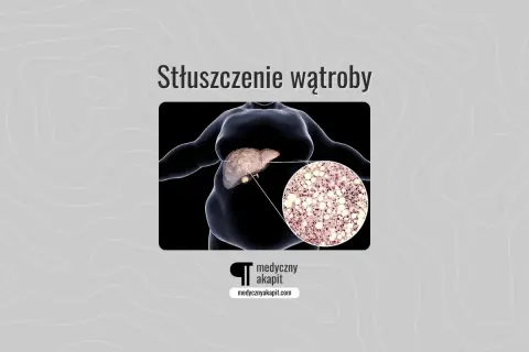 Stłuszczenie wątroby: powiększona wątroba z widocznym nagromadzeniem lipidów w komórkach.