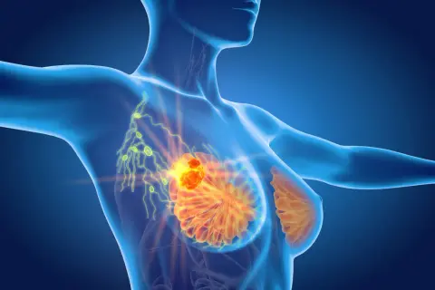 Widok anatomiczny ukazujący guz w piersi i powiększone węzły chłonne, sugerujące zapalenie węzłów chłonnych.