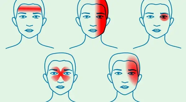 Ilustracje przedstawiają różne lokalizacje bólu głowy: czołowy, skroniowy, wokół oka, zatokowy i jednostronny.