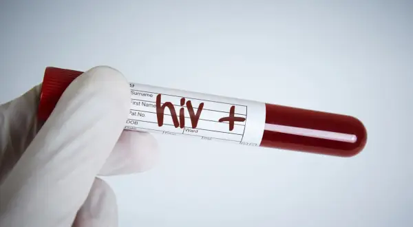 Rękawiczka medyczna trzyma probówkę z krwią oznaczoną "hiv +". Wynik testu na aids jest pozytywny.