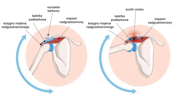 Ilustracja pokazuje anatomię barku, wyjaśniając przyczynę bólu barku. Po prawej stronie widać ucisk na ścięgno mięśnia nadgrzebieniowego.