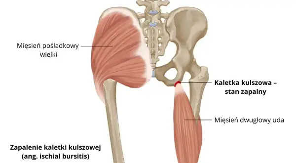 Zapalenie kaletki kulszowej, czyli stan zapalny w okolicy guza kulszowego, widoczny na tle miednicy i mięśni.