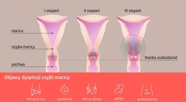 Grafika pokazuje stadia dysplazji szyjki macicy: I, II i III stopień, z zaznaczonymi objawami, takimi jak ból czy plamienia.
