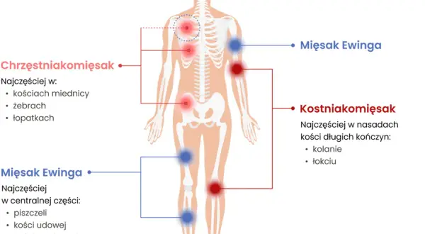 Schemat ciała ludzkiego z zaznaczonymi miejscami występowania mięsaków: chrzęstniakomięsaka, kostniakomięsaka i mięsaka Ewinga.