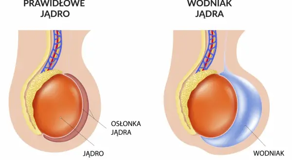 Porównanie prawidłowego jądra z jądrem dotkniętym wodniakiem. Wodniak jądra to nagromadzenie płynu.