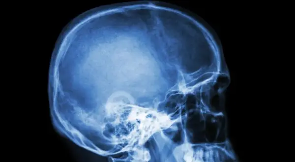 Rentgen czaszki z profilu. Widoczne struktury kostne głowy, w tym jama czaszki, kości twarzy i szczęka. Może to być pomocne w diagnostyce schorzeń wpływających na nerw błędny.