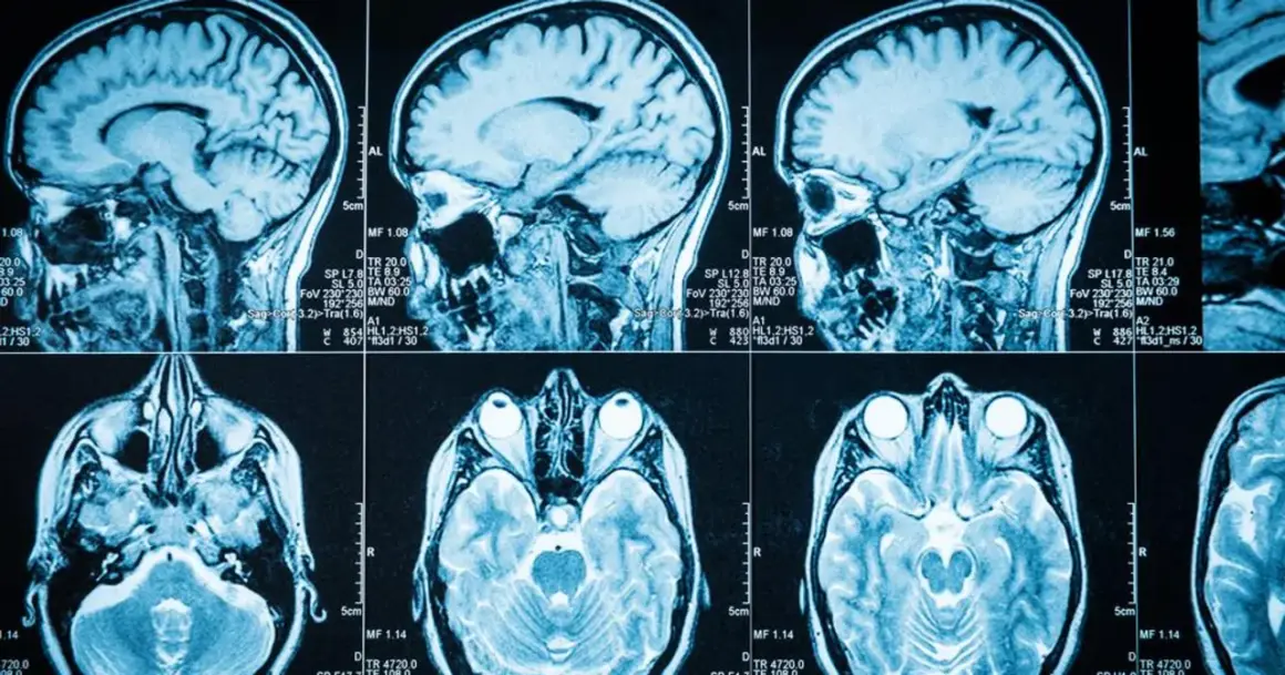 Przekroje mózgu na rezonansie magnetycznym. Widoczne są różne płaszczyzny badania, które mogą pomóc w diagnostyce takich schorzeń jak guz mózgu objawy.