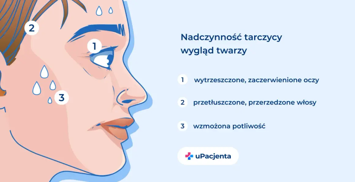 Chora tarczyca objawy: wytrzeszczone oczy, przetłuszczone włosy i wzmożona potliwość. Ilustracja twarzy z zaznaczonymi symptomami.
