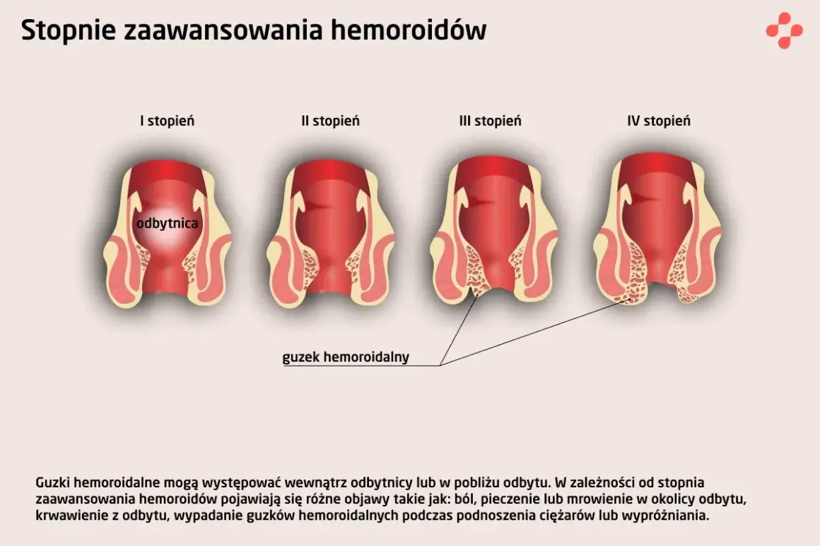 Ilustracja pokazuje cztery stopnie zaawansowania hemoroidów, od I do IV, z widocznymi zmianami w okolicy odbytu. W zaawansowanych stadiach może wystąpić krwawienie z odbytu.