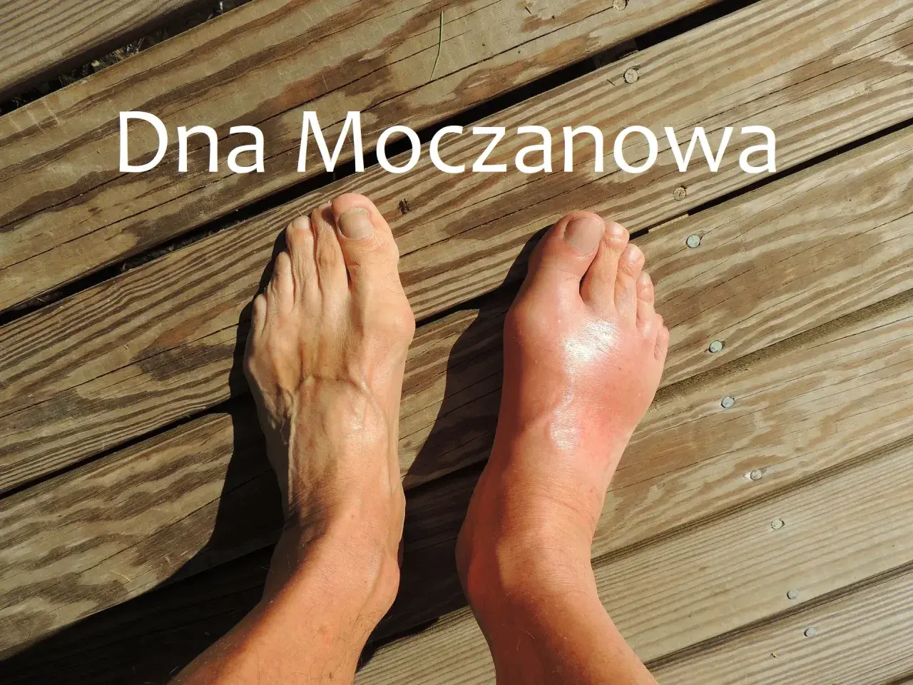 Ile można żyć z dną moczanową? Co wpływa na rokowanie