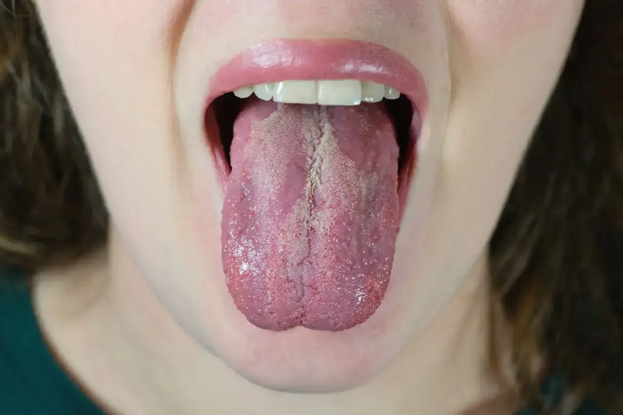 Język pokryty białym nalotem, widoczne grudki i zaczerwienienie. To mogą być objawy kandydozy jamy ustnej.