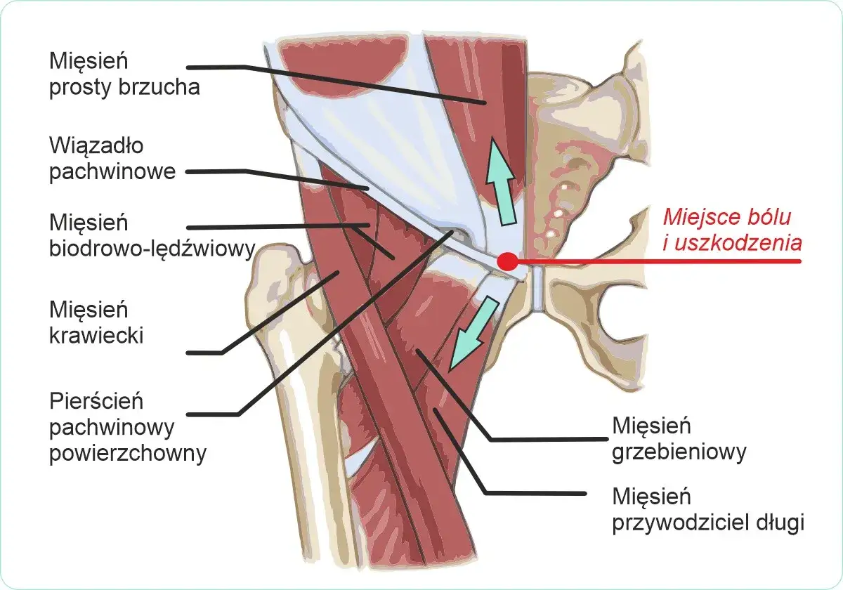 Anatomia pokazuje miejsce bólu w pachwinie promieniujący na nogę, związane z uszkodzeniem mięśni i więzadła pachwinowego.