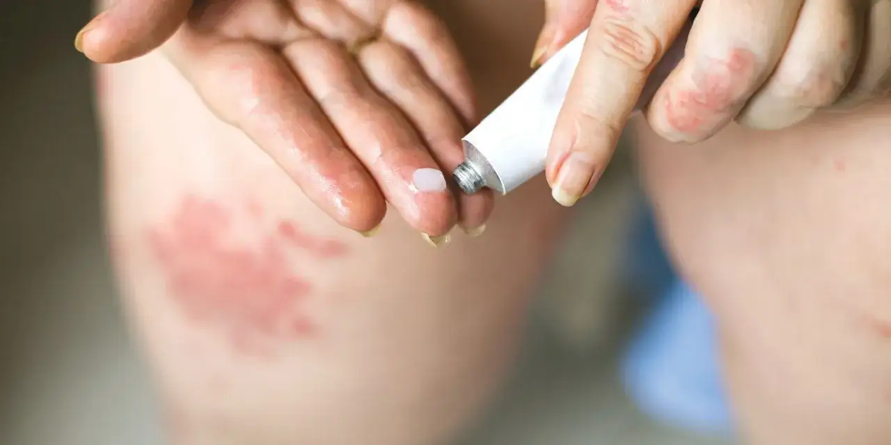 Dłoń z zaczerwienioną, suchą skórą nakłada krem locoid lipocream na zmiany.