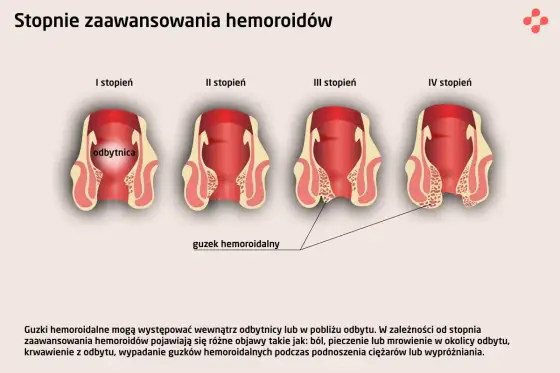 Krew z odbytu - kiedy to hemoroidy, a kiedy alarm?