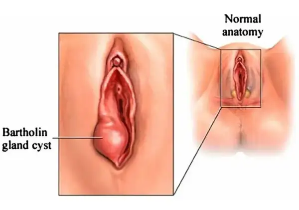 Ilustracja pokazuje powiększony gruczoł Bartholina, który jest powodem powstania torbieli. Obok widok prawidłowej anatomii.