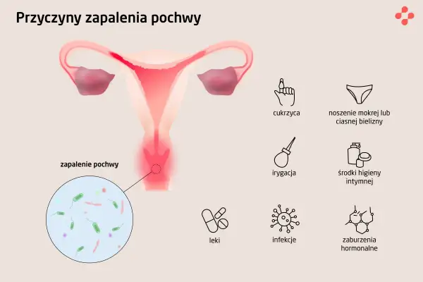 Ilustracja przedstawia przyczyny zapalenia pochwy, w tym infekcje intymne, cukrzycę i zaburzenia hormonalne.