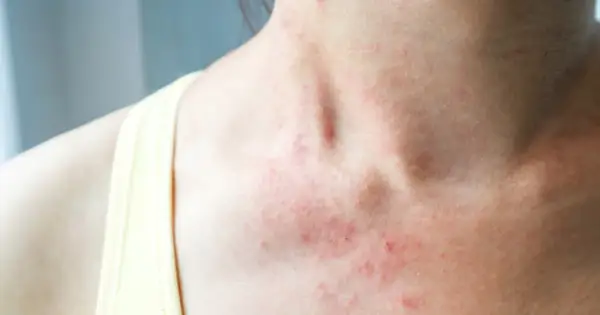 Skóra na szyi i dekolcie jest zaczerwieniona i podrażniona. Może to być objaw alergii lub innej choroby skóry, którą leczy się np. **locoid lipocream**.