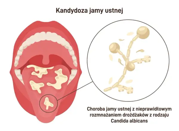 Obraz przedstawia jamę ustną z białymi nalotami na języku i podniebieniu, co jest objawem kandydozy. Powiększony fragment pokazuje drożdżaki Candida albicans.