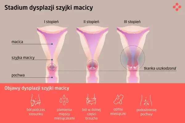Grafika pokazuje stadia dysplazji szyjki macicy: I, II i III stopień, z zaznaczonymi objawami, takimi jak ból czy plamienia.