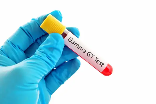 Rękawiczka z niebieskiej lateksu trzyma probówkę z krwią do badania Gamma GT. To badanie ocenia funkcję wątroby.