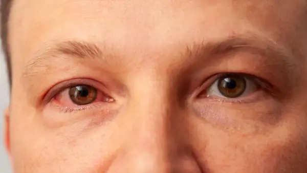 Czerwone, podrażnione oko z widocznym zapaleniem rogówki. Drugie oko wygląda zdrowo.