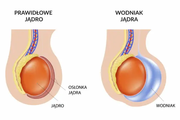 Porównanie prawidłowego jądra z jądrem dotkniętym wodniakiem. Wodniak jądra to nagromadzenie płynu.
