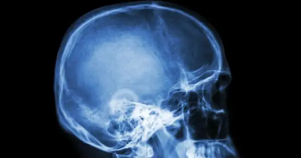 Rentgen czaszki z profilu. Widoczne struktury kostne głowy, w tym jama czaszki, kości twarzy i szczęka. Może to być pomocne w diagnostyce schorzeń wpływających na nerw błędny.