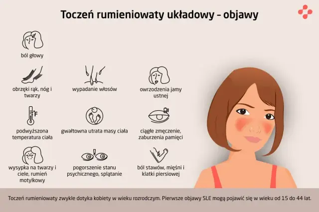 Toczeń rumieniowaty - objawy, badania i leczenie